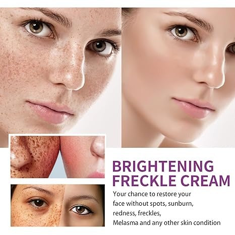 Spot Fading Urea Cream – Dark Spot Removal, Whitening & Freckle Reduction Cream